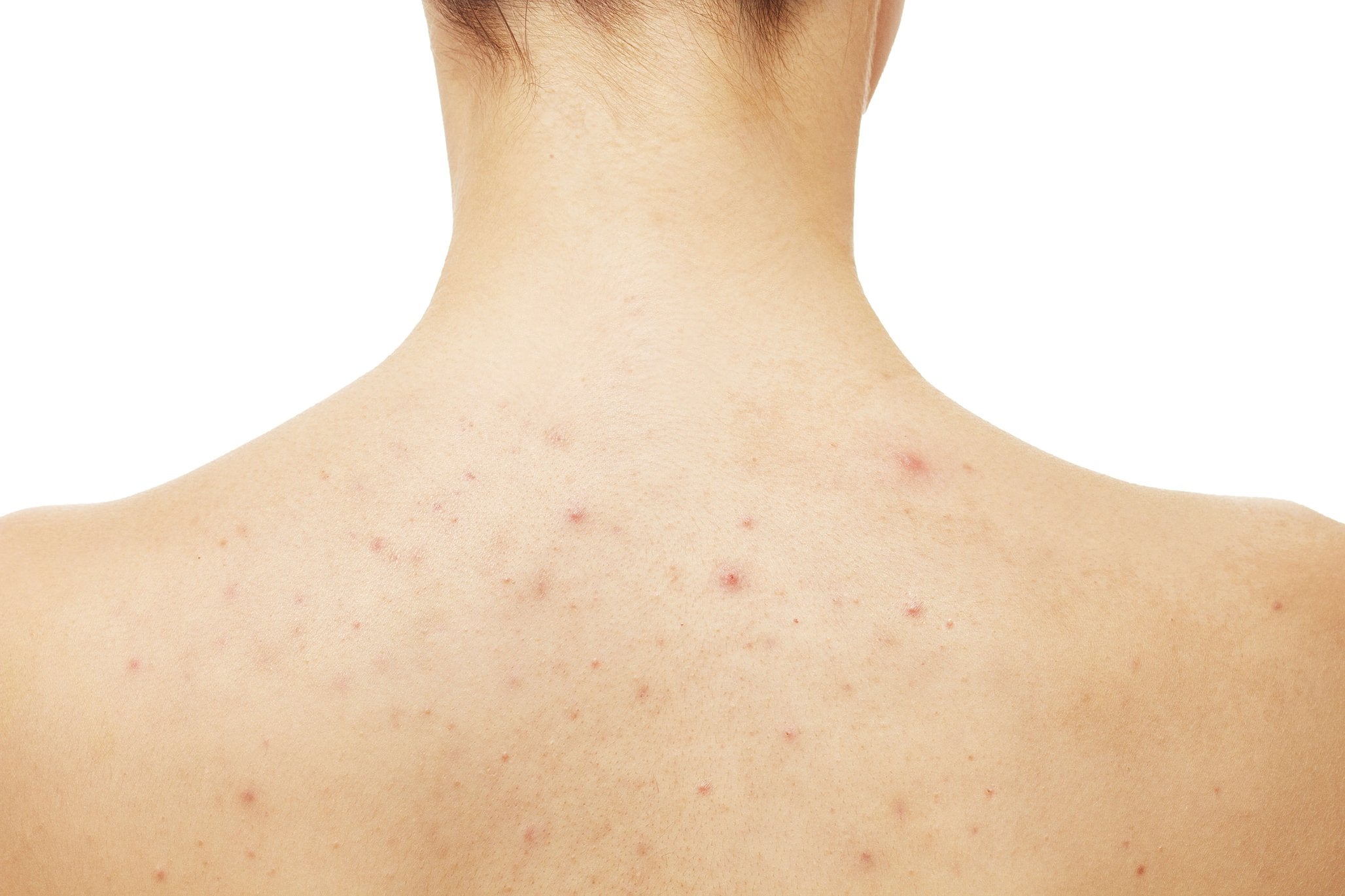 Undgå bumser på ryggen: Hvordan fjernes bumser på ryggen?