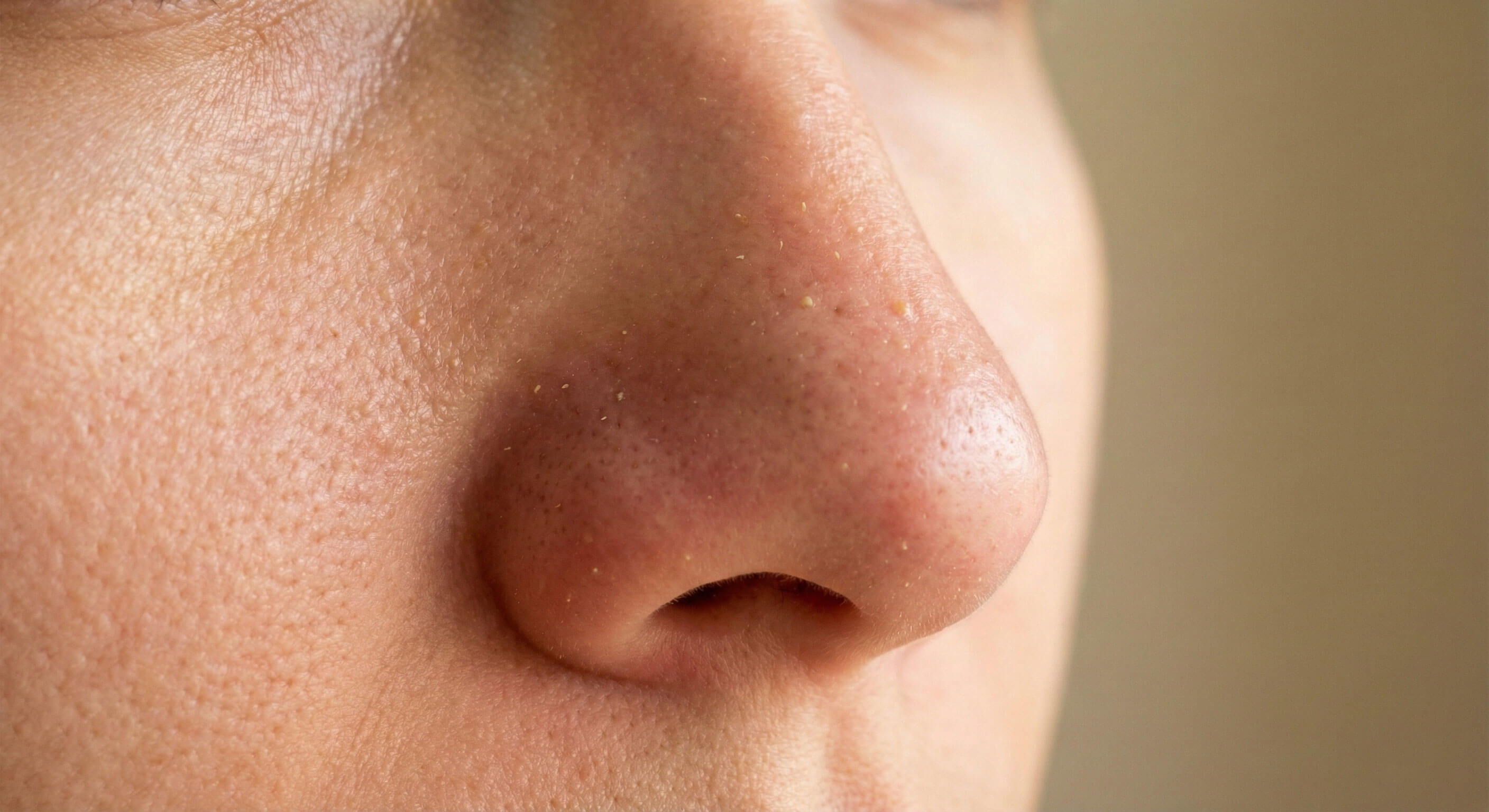 Fjernelse af talgknopper