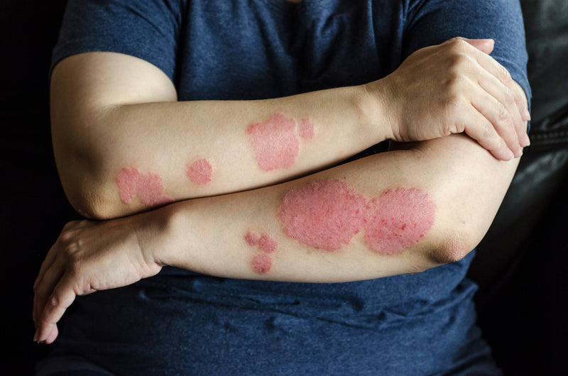 Behandling af Psoriasis