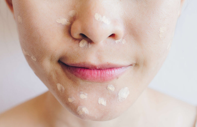 Kan man spotbehandle bumser?