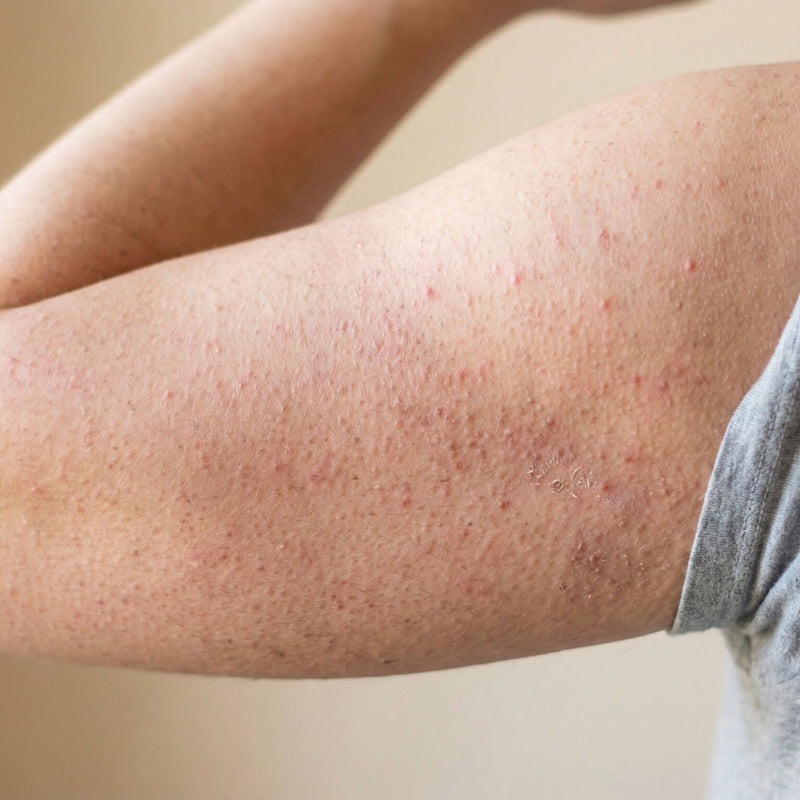 Keratosis Pilaris
