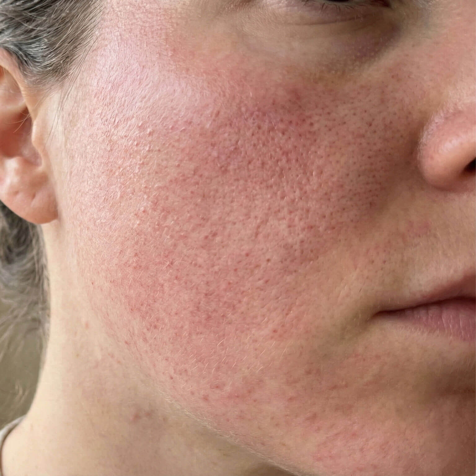 Rosacea