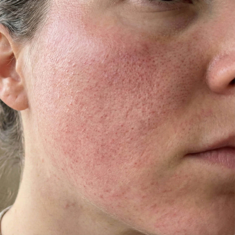 Rosacea