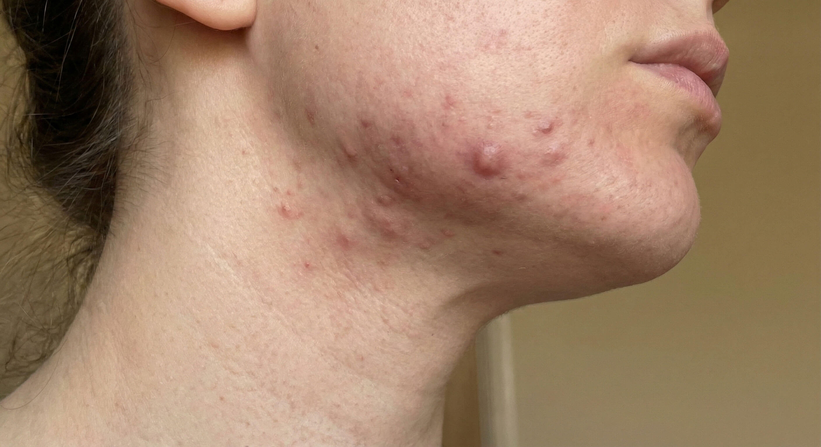 Sådan behandler du cyster bumser og indvendige bumser