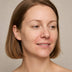 Perioral dermatitis