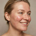 Rosacea